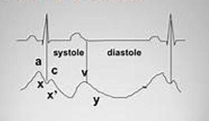 CVP waveform showing three positive waves labelled a, c and v, with x and y descents, aligned beneath an ECG rhythm strip showing the a wave following the P wave.