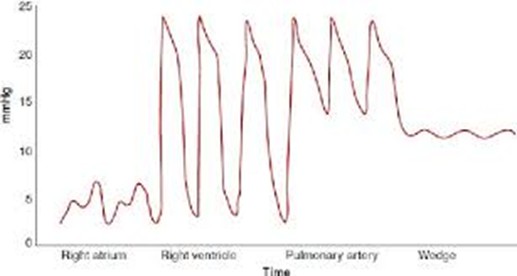  "Continuous pressure trace recorded while floating a pulmonary artery catheter, showing four sequential waveforms: low-amplitude right atrial trace with a, c and v waves; tall right ventricular trace with a low diastolic pressure and upsloping diastole; pulmonary artery trace with the same systolic peak but a raised diastolic pressure and a dicrotic notch; and a low-amplitude wedge trace with a and v waves after balloon inflation."