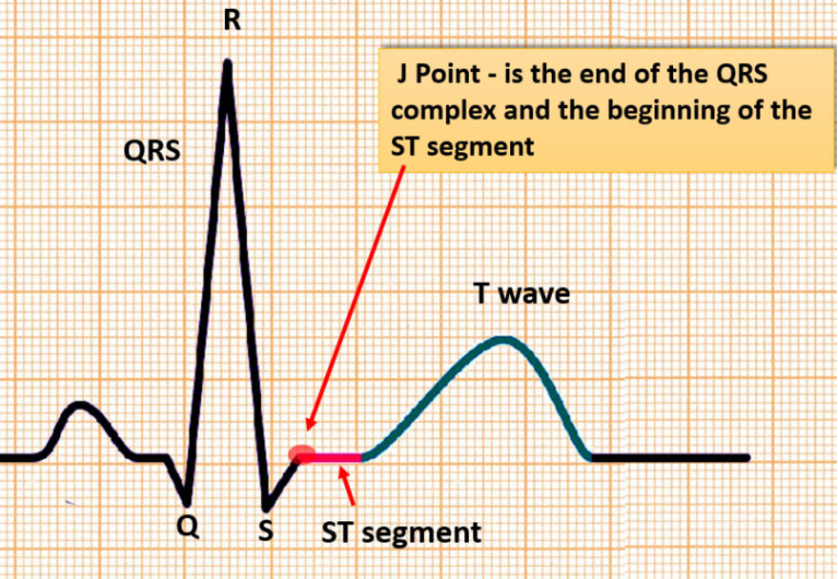 J point ECG image